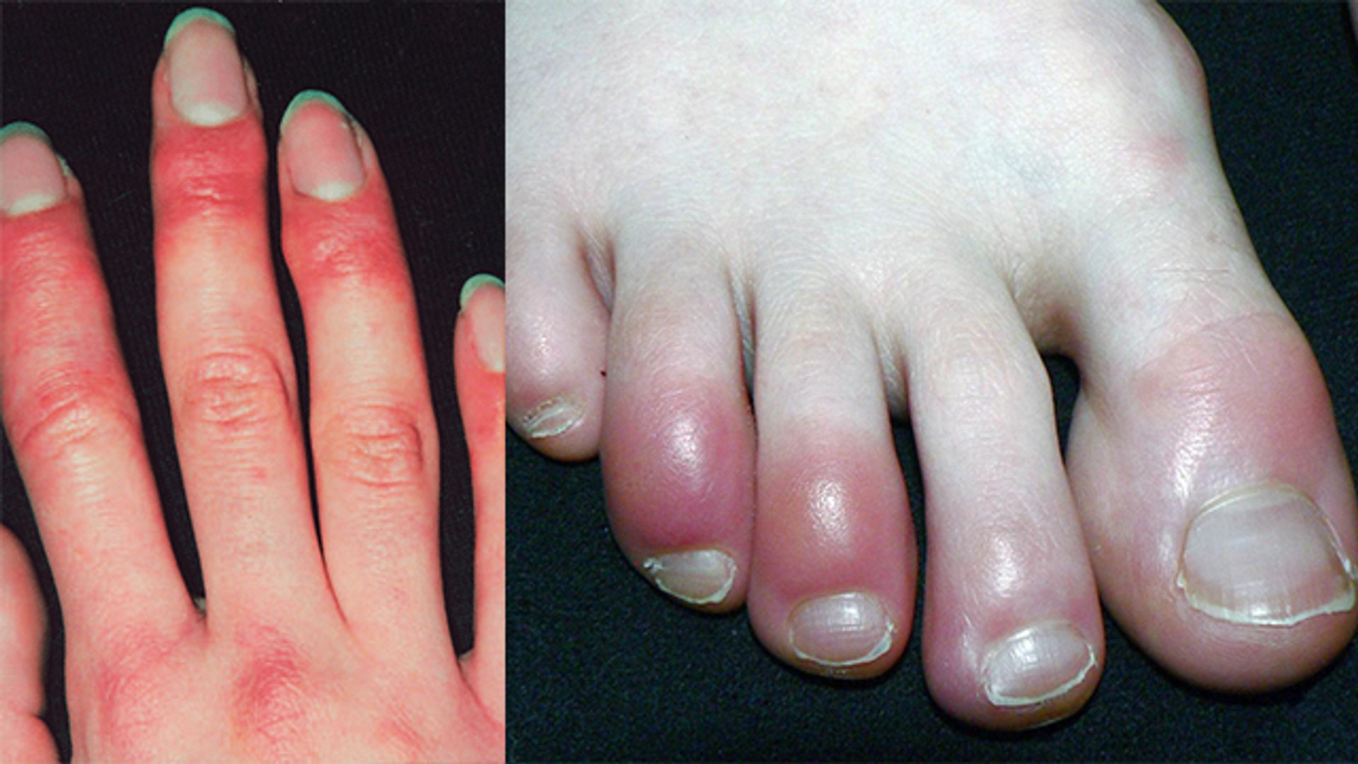 SWELLING IN FINGERS