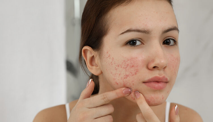 How to Get Rid Of Pimples -Natural Home Remedies