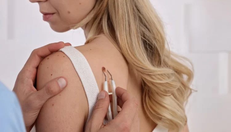 Home Remedies For Skin Tags- Our Top 11 Home Remedies