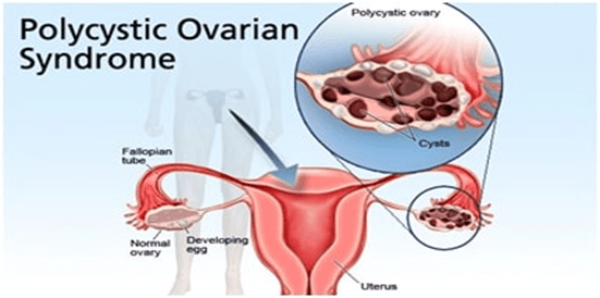 Poly Cystic Ovarian Syndrome