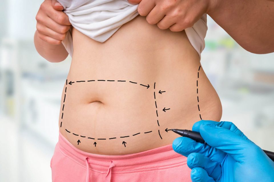 5 Incredible Benefits of Tummy Tuck Surgery