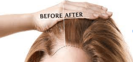 Female Hair Transplant in Hyderabad - has over 15 years of experience
