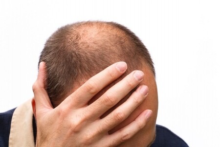 Is baldness contributing to a lack of self-esteem