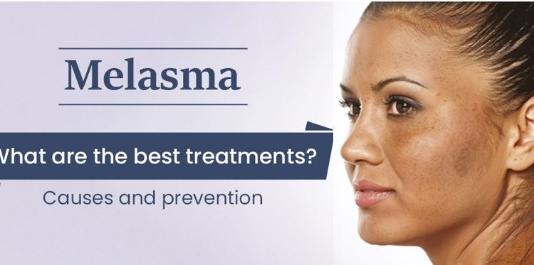 Melasma: What are the best treatment