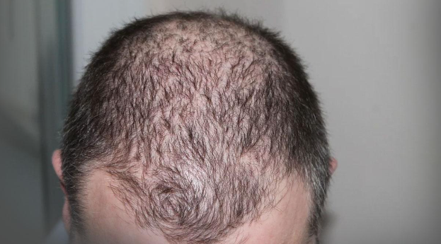 Will Hair Loss Stop When Ferritin Rises?