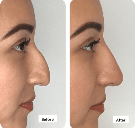 The Benefits of Non-Surgical Rhinoplasty for Nose Reshaping