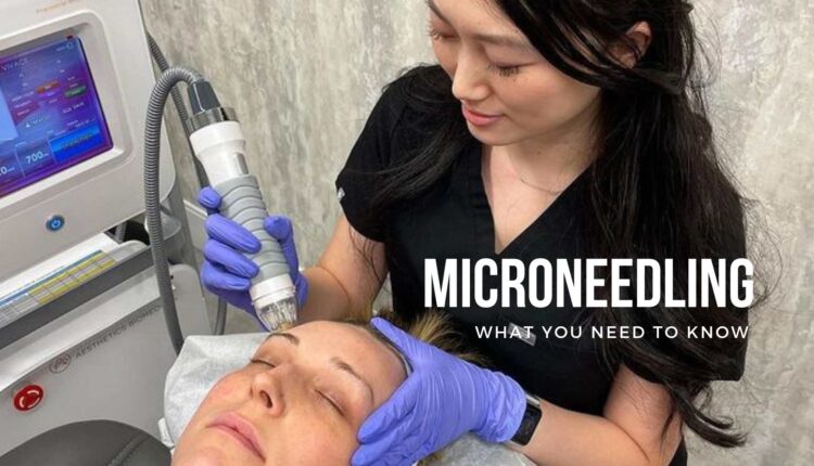 Microneedling What You Need to Know