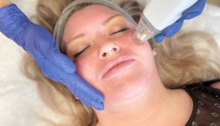 Potenza RF Microneedling - Transform Your Skin with LASERSKIN.CA