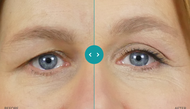 Tips to Defy Sagging Eyelids with Remescar