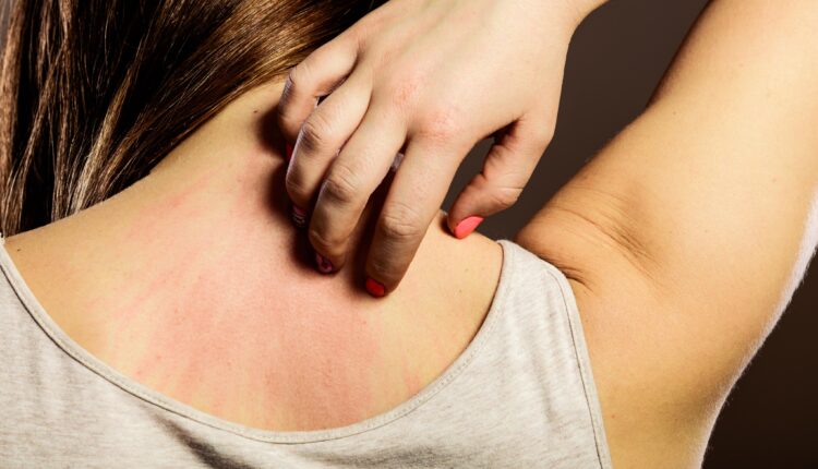 5 Skin Conditions to Watch Out For